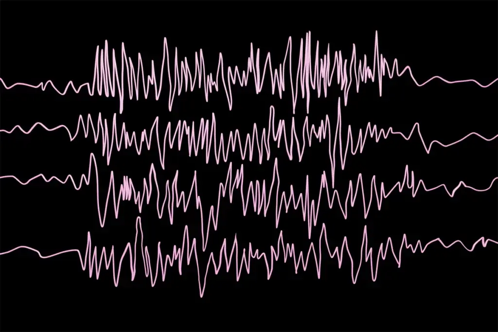 Illustration of brain waves during an epileptic seizure.