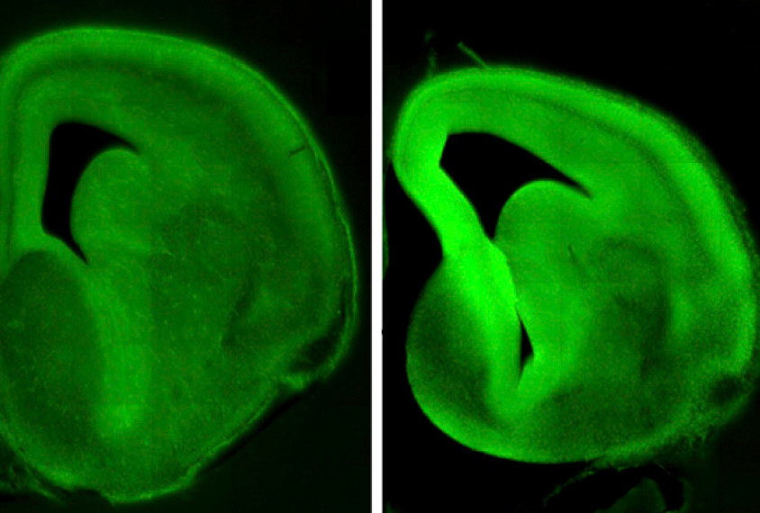 A mutation in a human-specific DNA