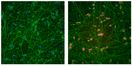 Deleting DNA repeats from fragile X neurons restores expression (right, red) of the gene silenced in the syndrome.