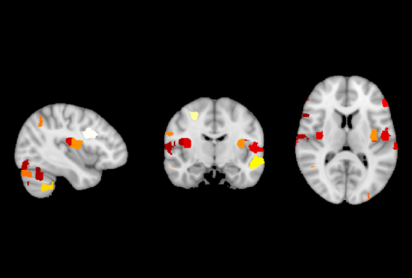 In Autism Brains, Neurons May Take Up More Space Than Usual 