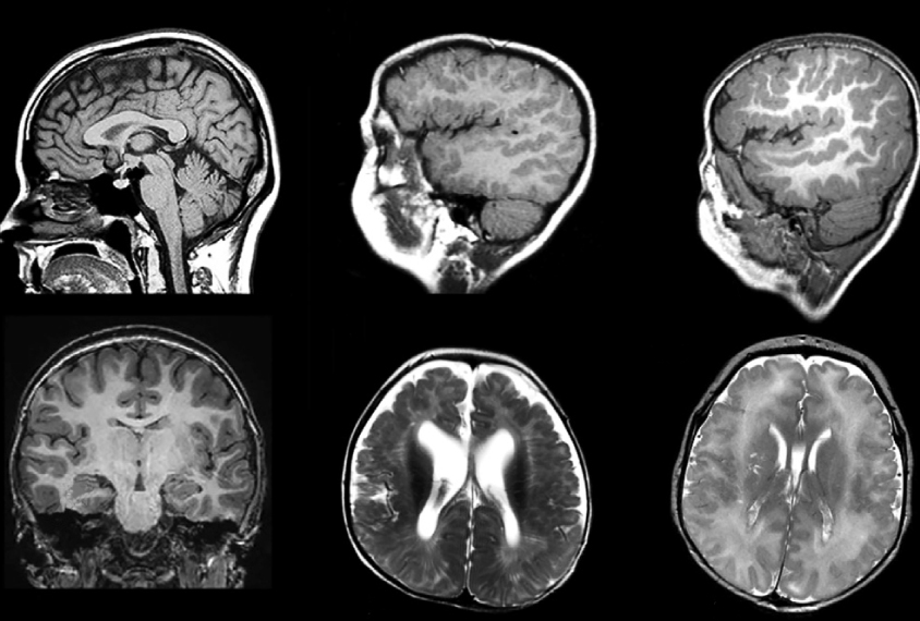 MRI scans of a child's brain with DDX3X mutation