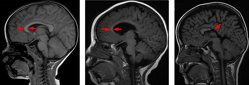 three MRIs with the corpus callosum highlighted by red arrows