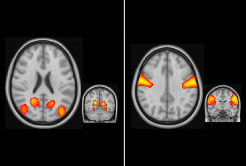 four brain views with different areas lit up