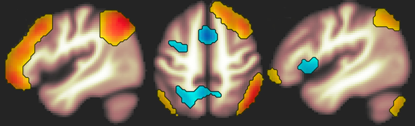 brain scan FPN