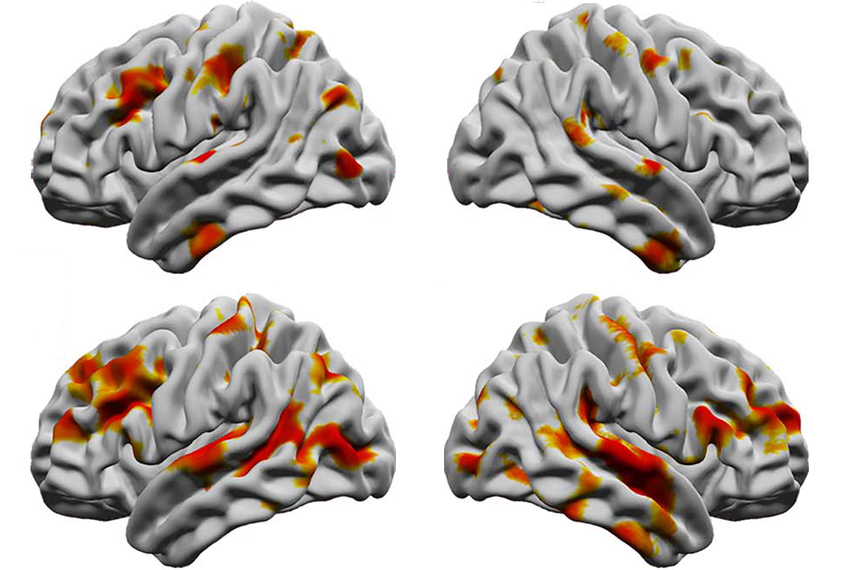 Brains scans reveal sharper boundaries between white and gray matter in autistic people.
