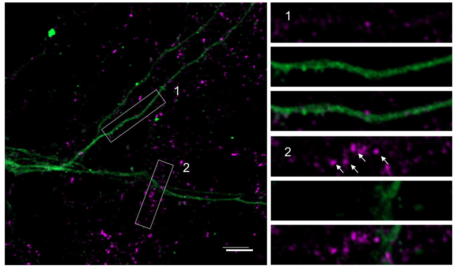 Series of micrographs of synapses in stressed mice with mutated SHANK3 gene showing high expression of HOMER1A protein and loss of SHANK3.