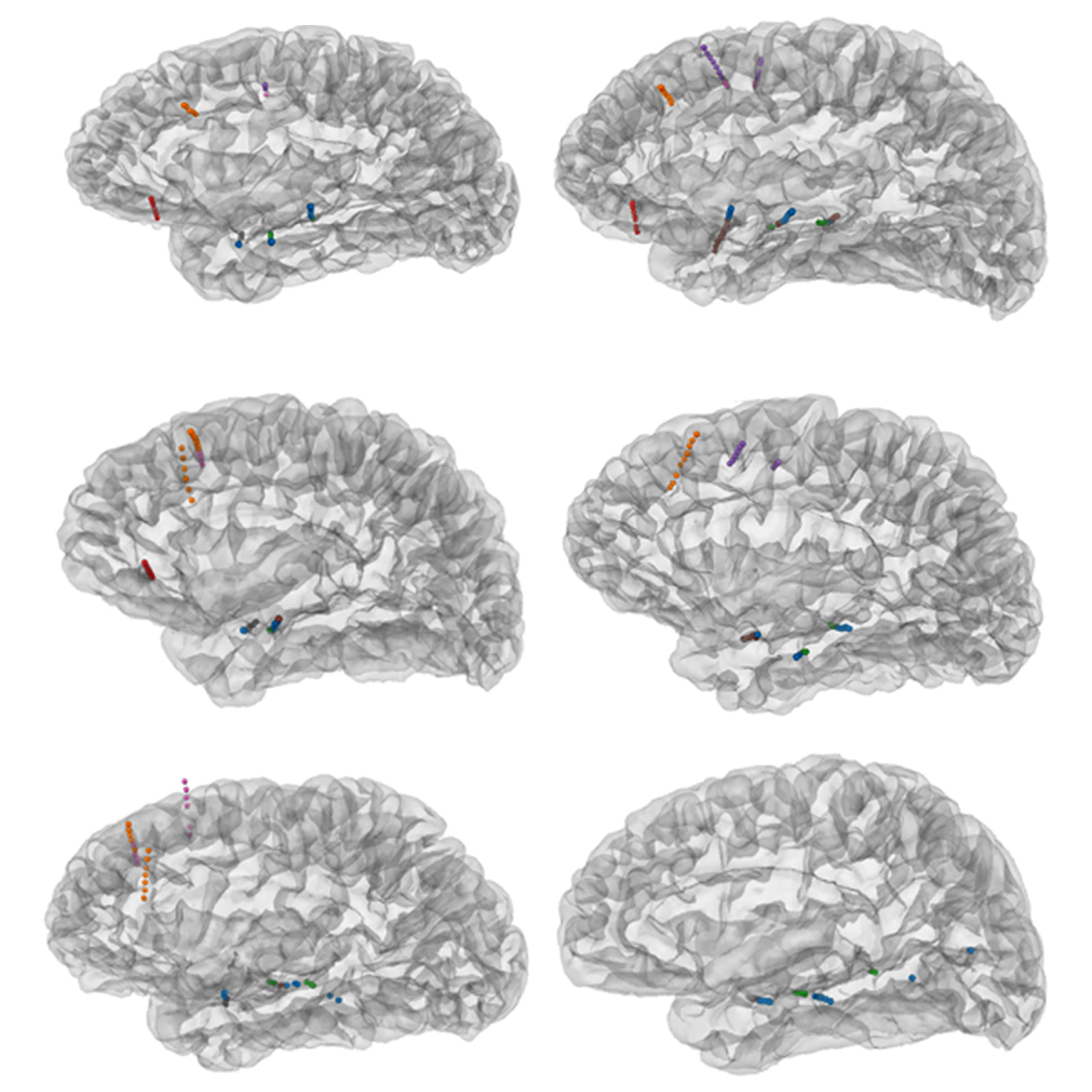 AI model helps decode brain activity underlying conversation