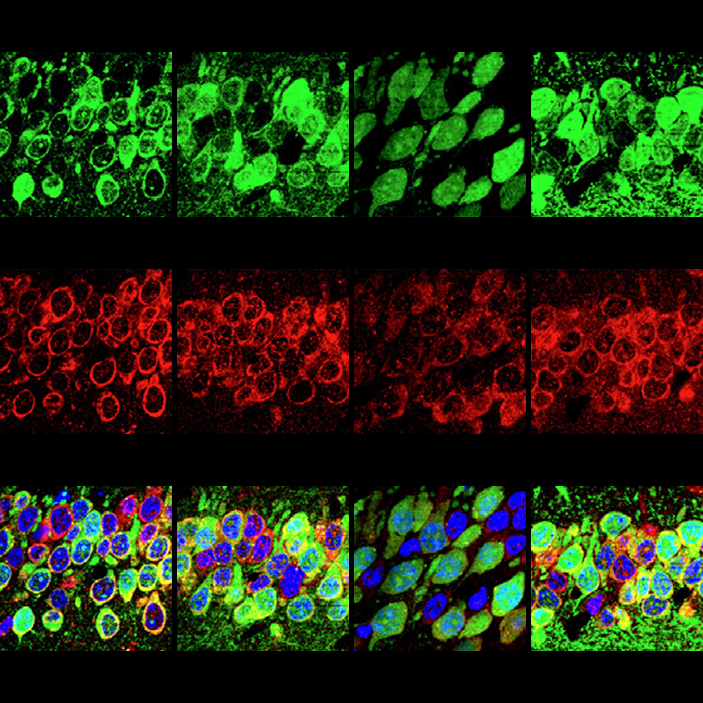 Neuronal deafness to stress may add to protein surplus in fragile X