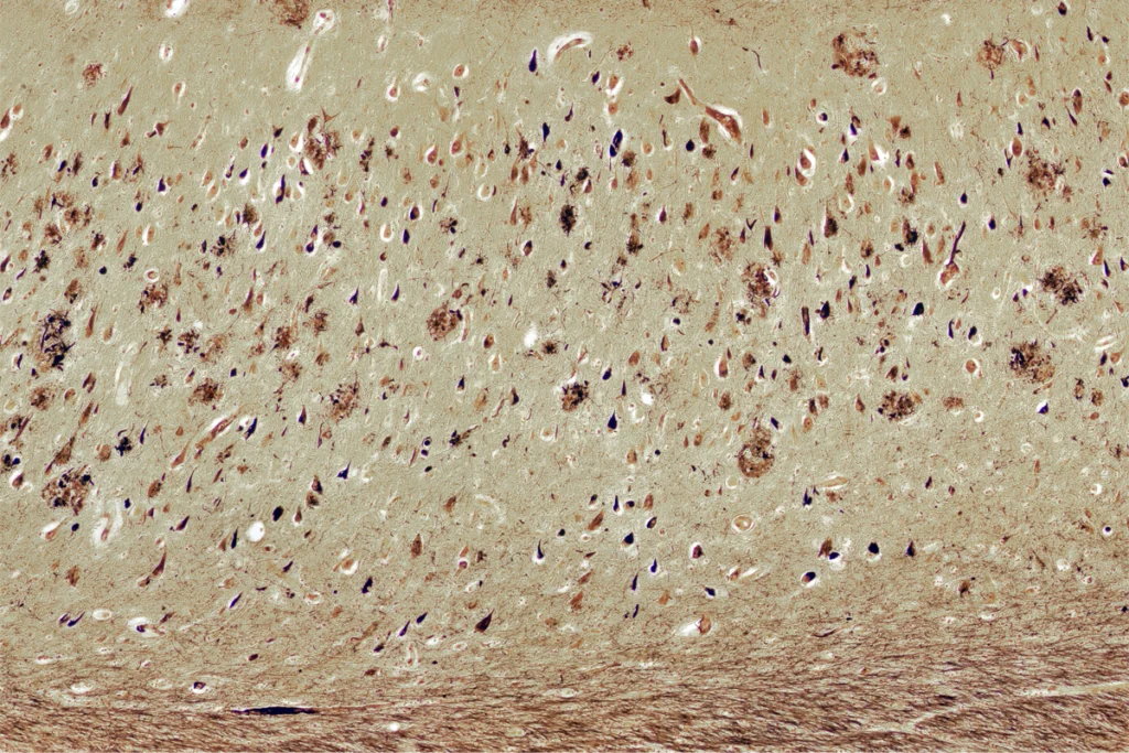 Image of amyloid beta plaques.
