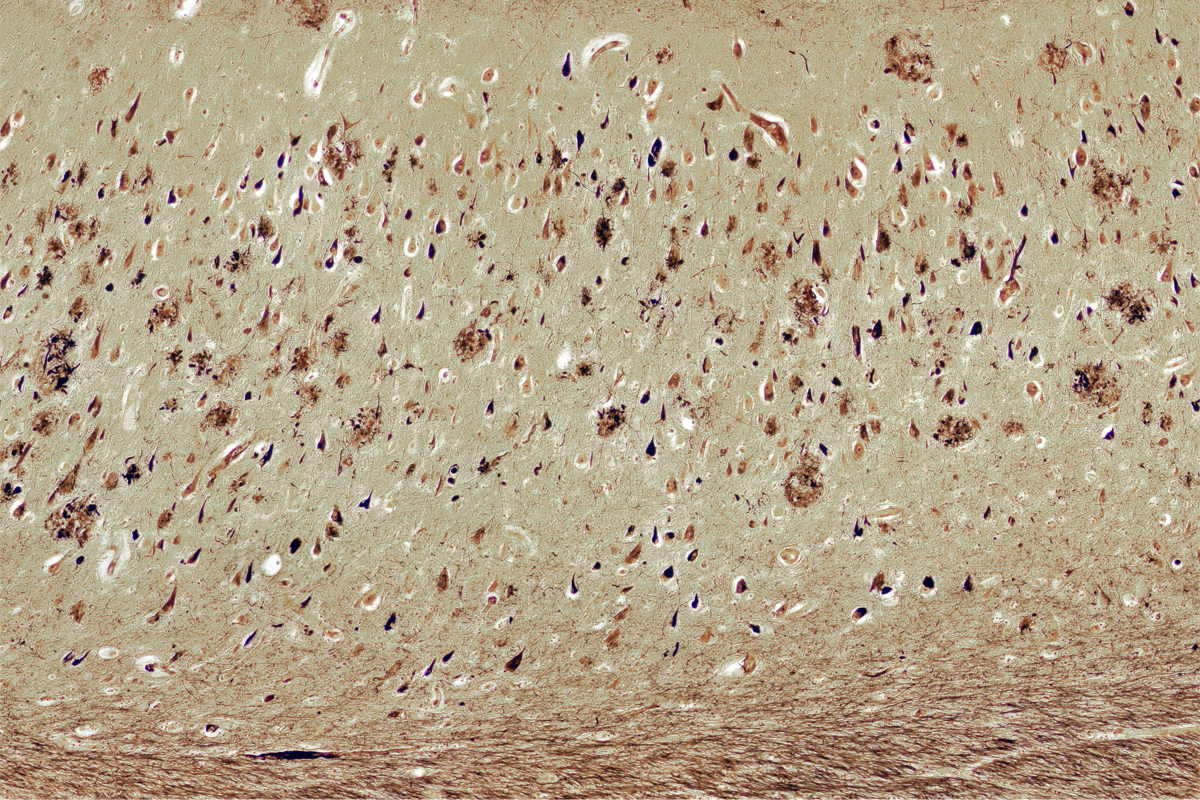 Image of amyloid beta plaques.