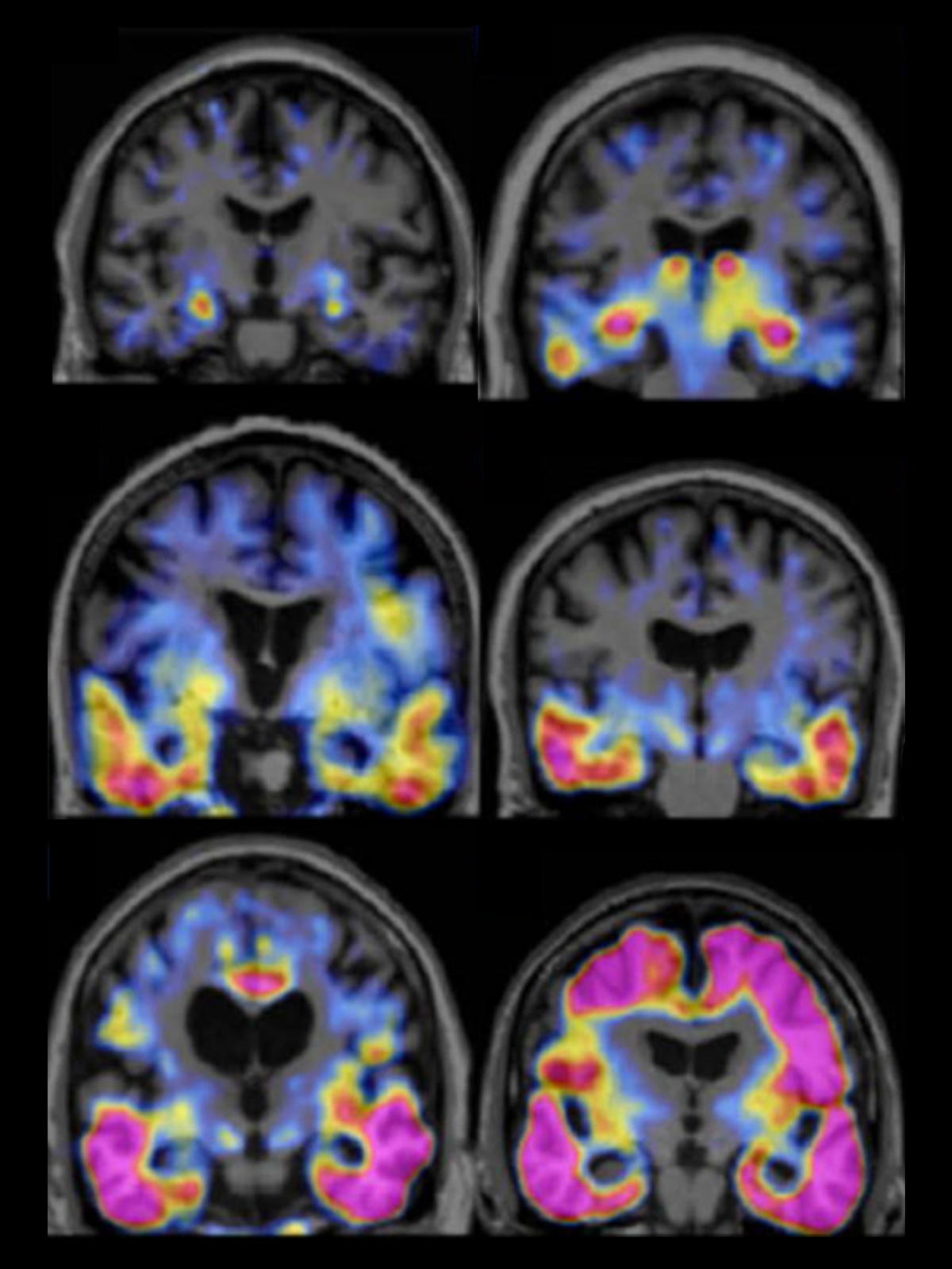 Research image of tau proteins in the brains of people with Alzheimer’s disease.