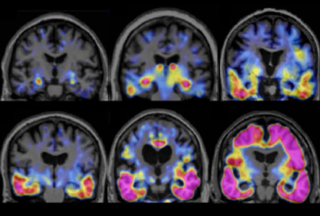 Research image of tau proteins in the brains of people with Alzheimer’s disease.