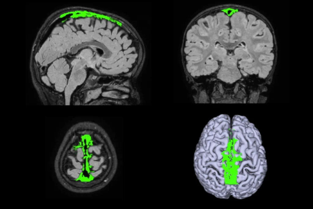 Research image of four brain scans with green areas indicating Parasagittal dura volume.