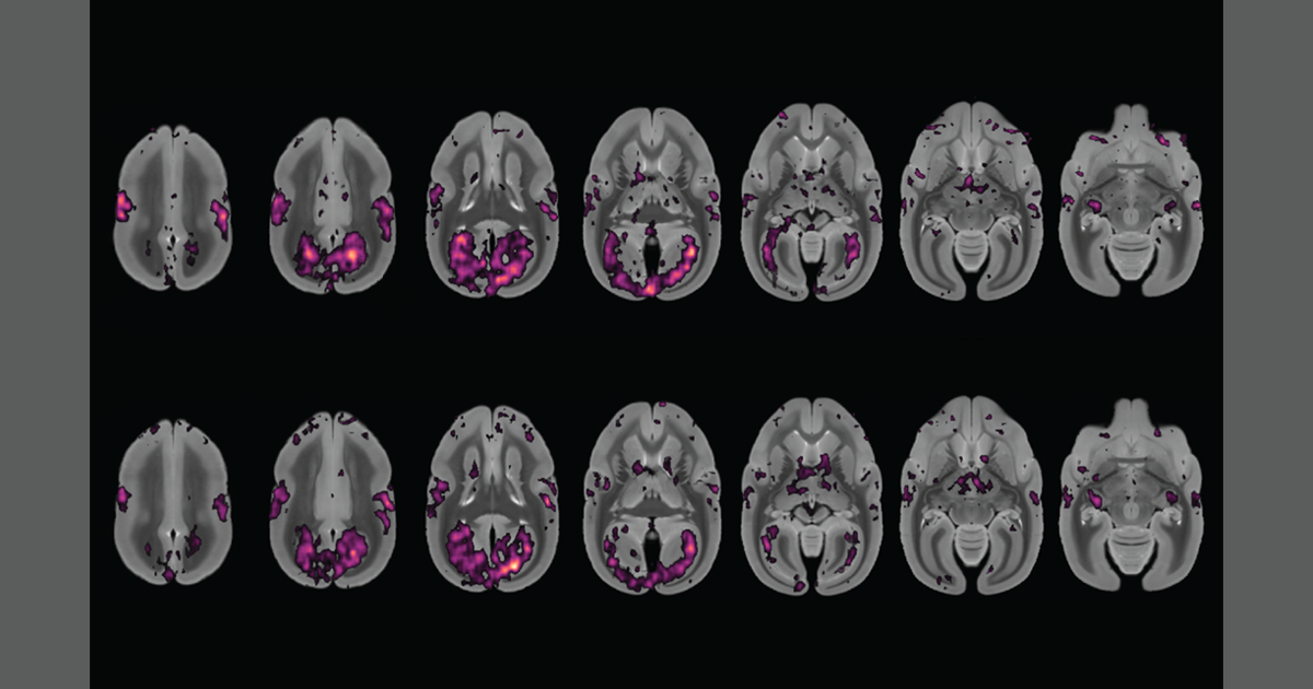 Il quadrante temporale trasforma le scansioni fMRI scartate in un tesoro