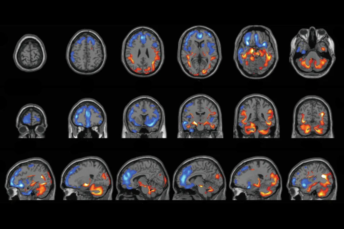 Research image of human brain scans against a black background.