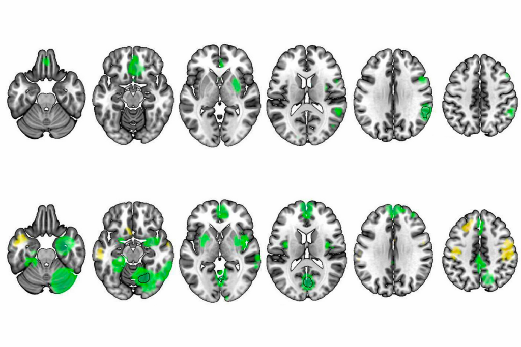 Research image of gray-matter volume in the brains of people with autism (bottom row) and attention-deficit/hyperactivity disorder (top row).