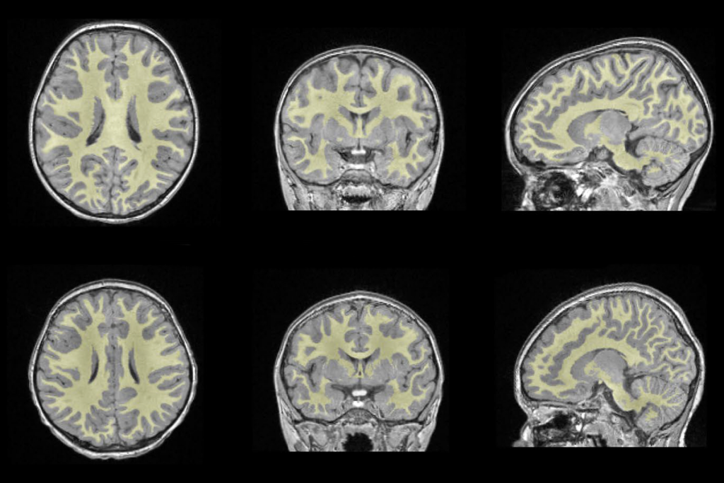 Research image showing white matter volume in a child with Angelman syndrome compared with a child without the condition.